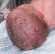 Bruising on newborn Naomi from the vacuum-extraction cap