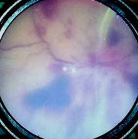 retinalhemorrhagesSmall